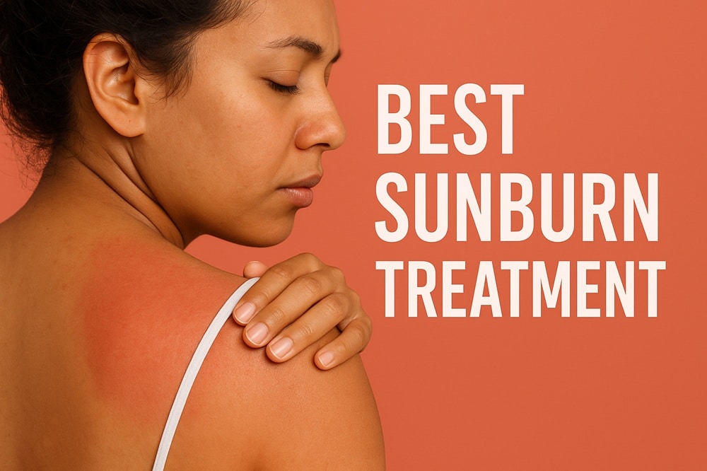 best sunburn treatment